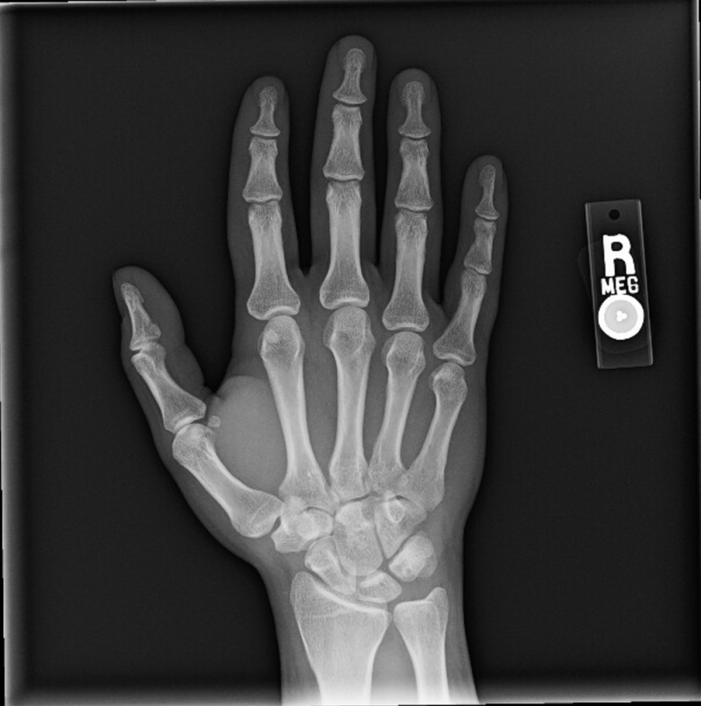 An x-ray image of a right hand, palm flat.