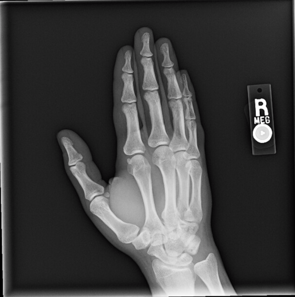 An x-ray image of a right hand, at an angle.