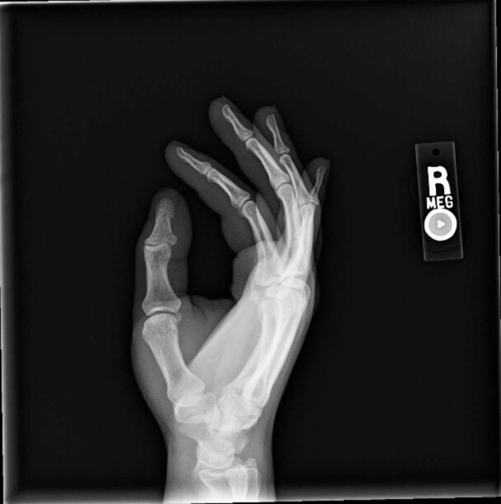 An x-ray image of a right hand, side on.